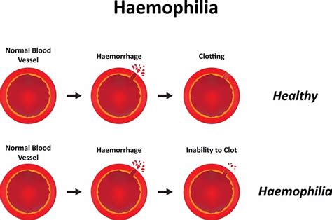 Types and causes of blood clots