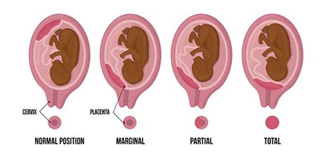 Placenta Accreta Vs Normal Placenta