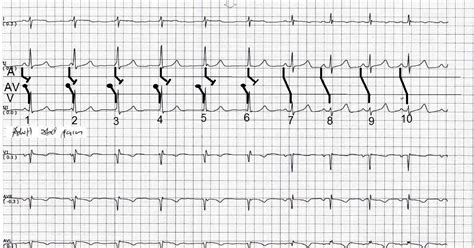 ECG Channel: AV dissociation