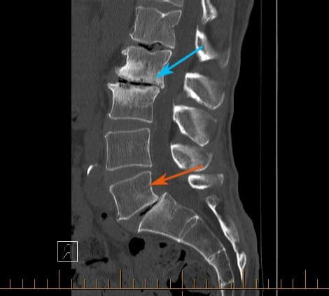 CT Scan Lumbar Spine - Diagnostic Imaging - Melbourne Radiology