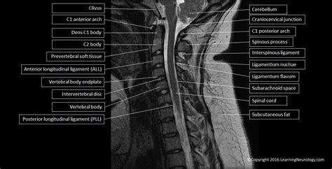 Approach to MRI Spine | LearningNeurology.com