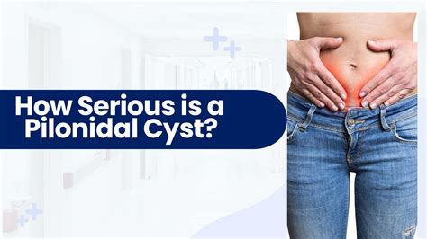 Find The Best Pilonidal Cyst Surgery Treatment in CA by Pilonidal ...