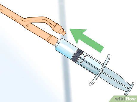 How to Irrigate a Foley Catheter (with Pictures) - wikiHow