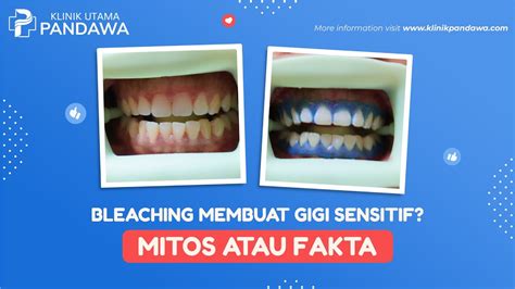 Bleaching Gigi - Treatment dan Informasi Lengkapnya | Klinik Utama ...