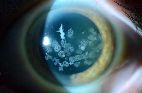 Corneal Scar Treatment