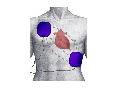 Correct AED Pad Placement - First Aid for Free