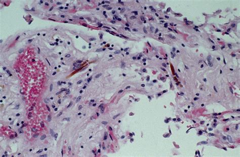 Light Micrograph Of Asbestos Fibres In Lung Tissue Photograph by Dr. E ...