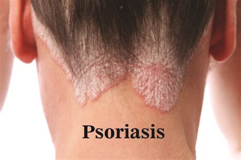 Psoriasis : Symptoms, Causes and Treatment - Dr. Anki Reddy's