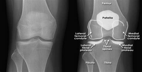 Sprain Knee X Ray