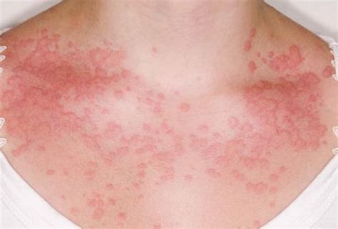 Child Rash Treatment: skin rash solution for women