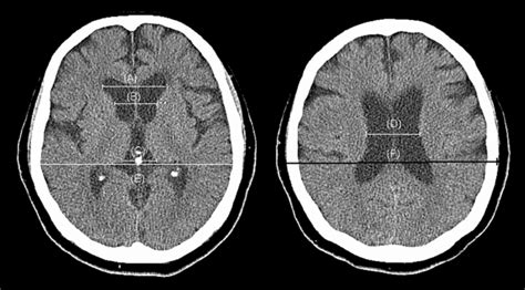 Normal Brain Mri Ventricles