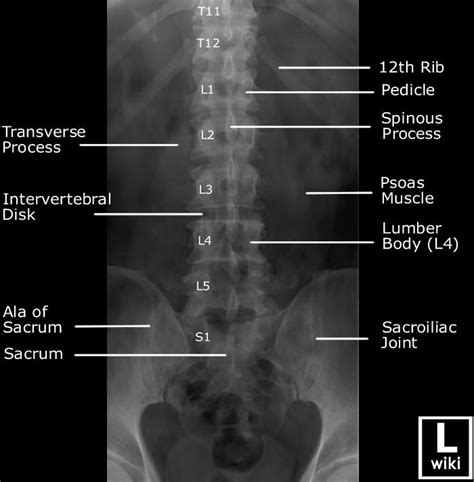 Lumbar Spine Radiographic Anatomy | Medical radiography, Radiology ...