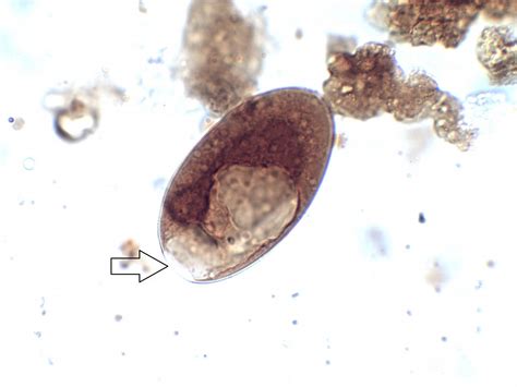 Fasciolopsis buski – Egg – Parasitology