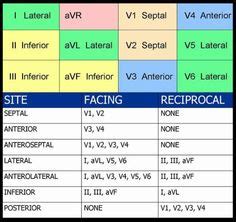 12 Lead and STEMI Placement | Nursing | Pinterest