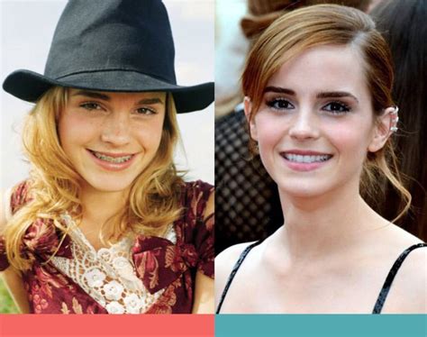 Celebrities With Braces - Celebrities With Braces Want To Look Like ...