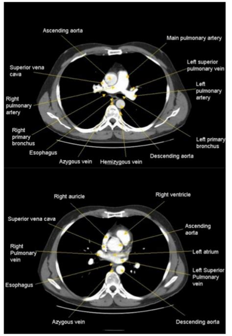 112 best Imagenes de CT SCAN y MRI images on Pinterest | Hematology ...