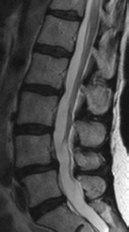 Mri Lumbar Spine Without Contrast | Renew Physical Therapy