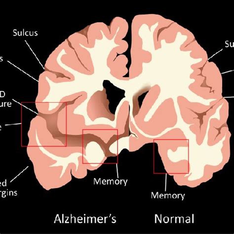 Macroscopic changes. Atrophy of the hippocampus and cerebral cortex ...