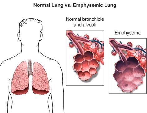 Emphysema Treatment in New Jersey | Lung, Thoracic Care