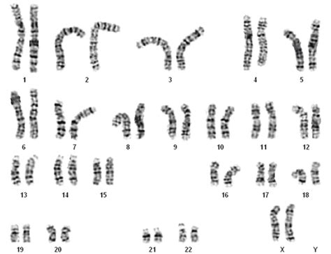 Karyotype showing normal female genotype with two X chromosome ...