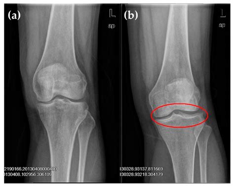 Xray Knee Osteoarthritis