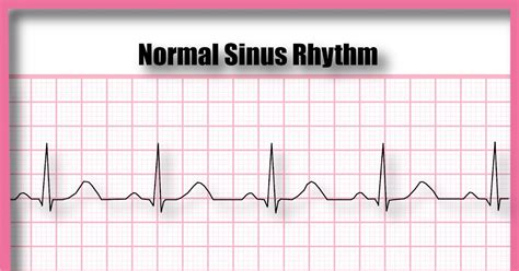 Normal Sinus Rhythm