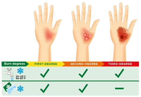 First Degree Burn Hand