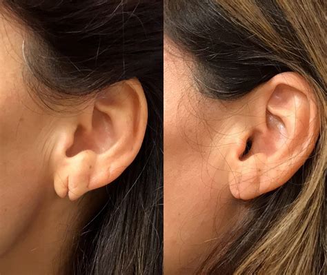 Earlobe Repair Before & After Photos - Upper East Side New York, NY