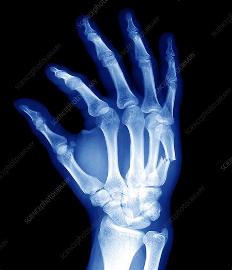 Broken hand bone, X-ray - Stock Image - M330/0968 - Science Photo Library