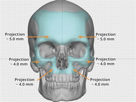 Custom Forehead Brow Bone and Midface Implant measurements Dr Barry ...