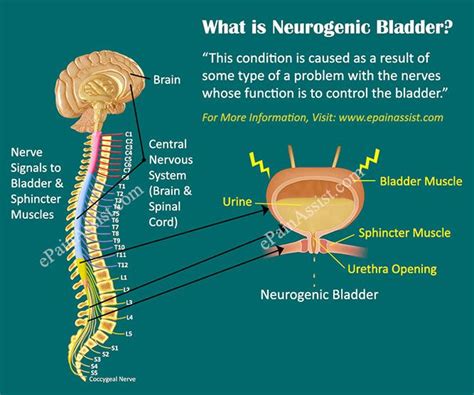 What Is Neurogenic Bladder? | Bladder, Bladder incontinence, Medical ...