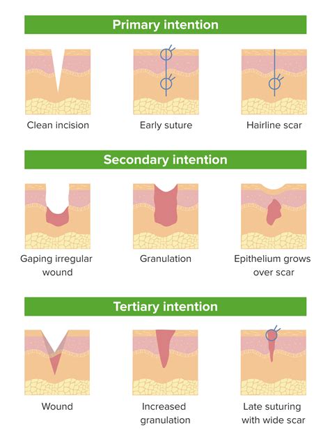 Wound Healing Steps