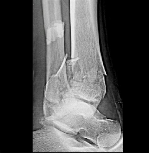 Tibial Plafond Fractures - Trauma - Orthobullets