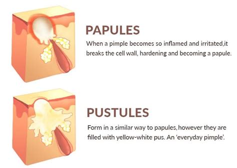 How To Get Rid Of Papules | Papules acne, Types of acne, Acne treatment