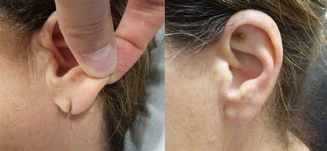 Earlobe Repair - Dr. David Seidman | ENT Queens New York