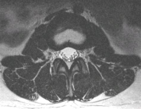 Axial Lumbar Anatomy