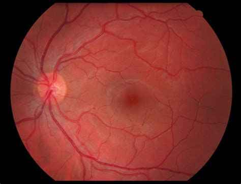 What is the Retina? Retinal detachment and other retinal issues.