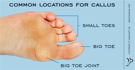 Intractable plantar keratosis