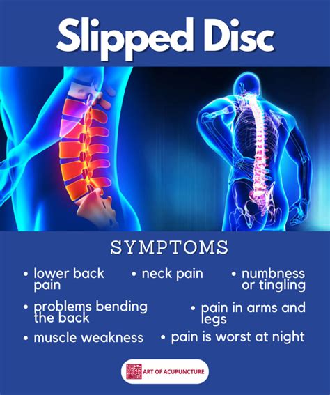 Slipped Disc Symptoms - Art of Acupuncture