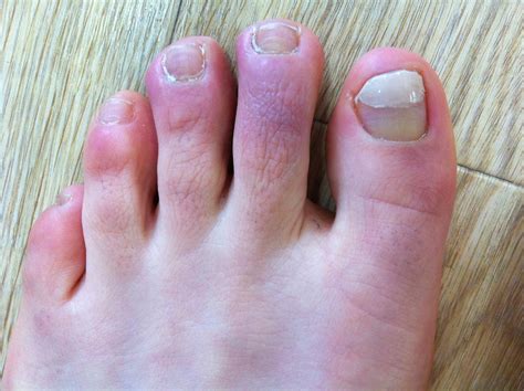 chilblains | Weird lump on my fourth toe. Swollen. | stacyfaces | Flickr