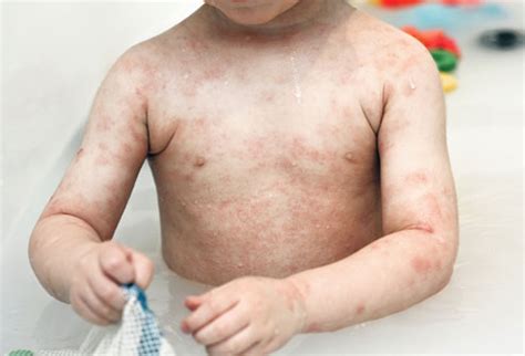 Eczema in Children Treatment - Eczema Free Skin