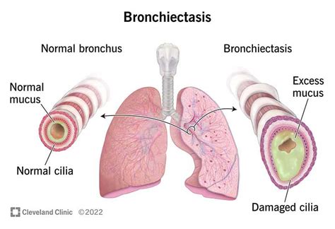 Understanding Bronchiectasis: Causes, Symptoms, And Treatments - Ask ...