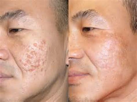 ACNE SCARS LASER RESURFACING: Essence Medispa: Cosmetic Dermatology