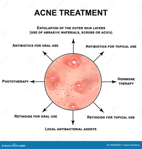 Acne Treatment. Pustules, Papules, Comedones, Blackheads, Acne on the ...