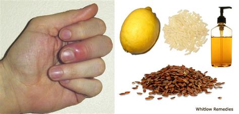 Home Remedies for Whitlow | Reduce Risk of Whitlow