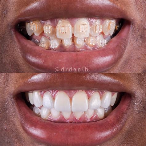 Teeth Veneers Before And After