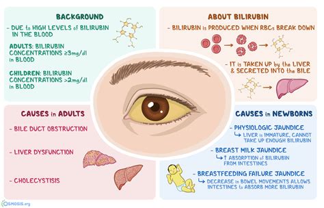 Scleral Icterus: What Is It, Causes, and More | Osmosis