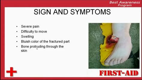 Sign and symptoms of Fracture, identification of fracture, clinical ...