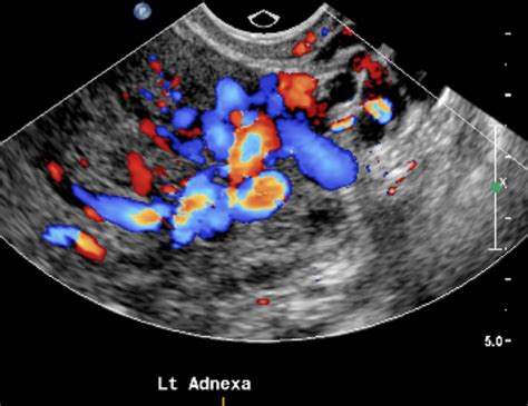 Pelvic Congestion Ultrasound