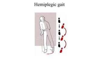 Hemiplegic gait | PPT